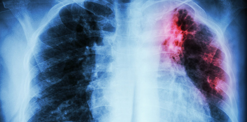 What You Need to Know About TB and Antibiotic Misuse